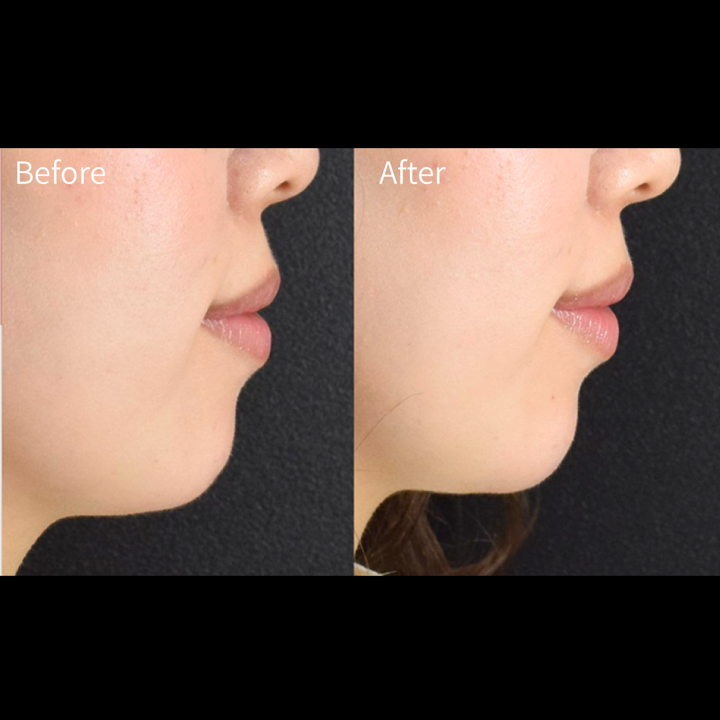 ヒアルロン酸の症例画像