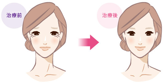 目尻の表情シワの治療前と治療後のイラスト